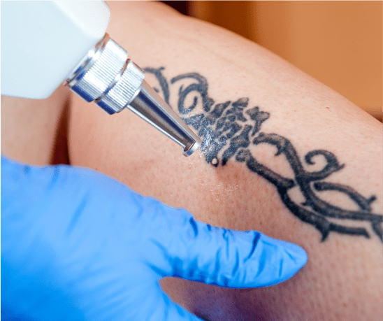 Tattoo Removal