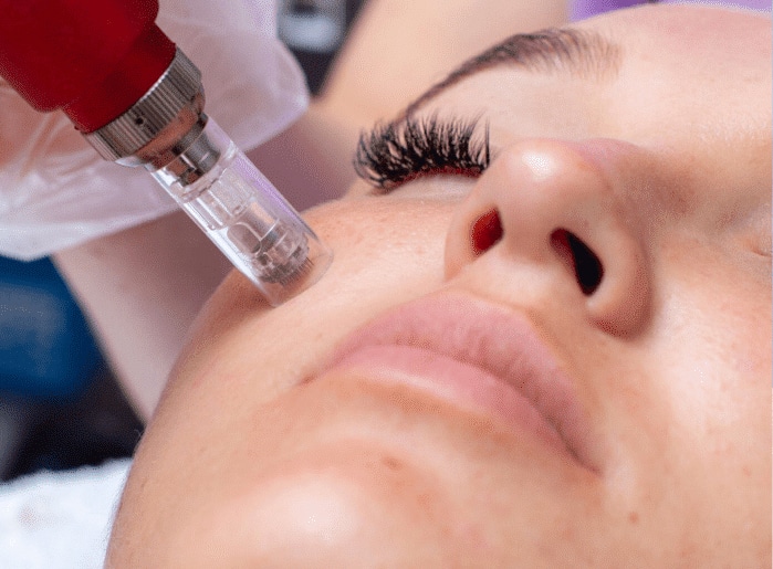 How Often Should You Get Microneedling?