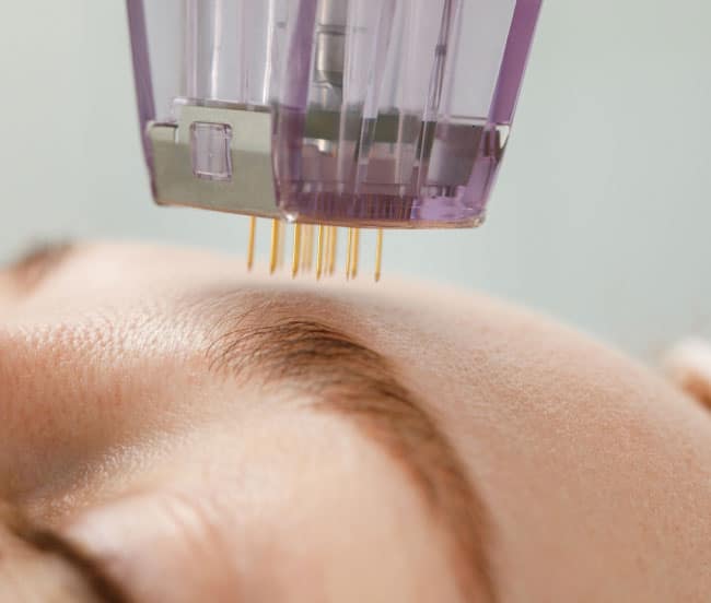 microneedling forehead