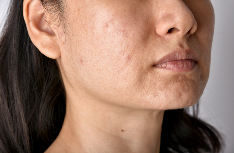 face with acne scars