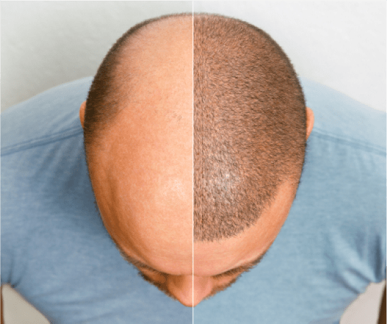 hair transplant comparison