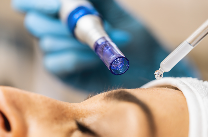 woman undergoing a microneedling procedure