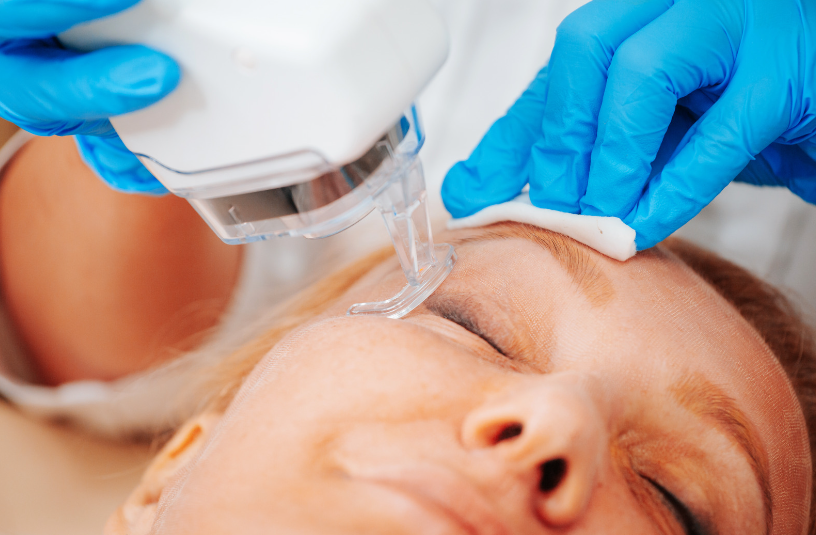 woman undergoing laser resurfacing