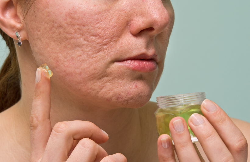 woman with acne scars applying topical ointment