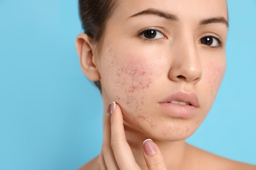 woman with acne scars